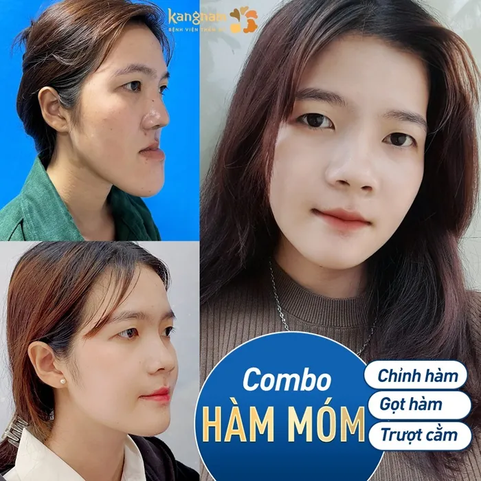 Độn cằm rạch ở đâu?