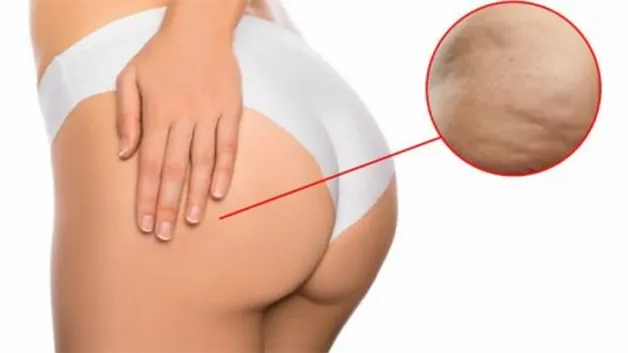 Tẩy tế bào chết cho mông có tác dụng gì