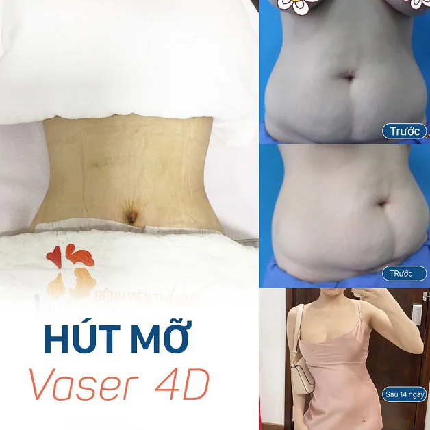 Kết quả trước và sau khi khách hàng hút mỡ Vaser 4D
