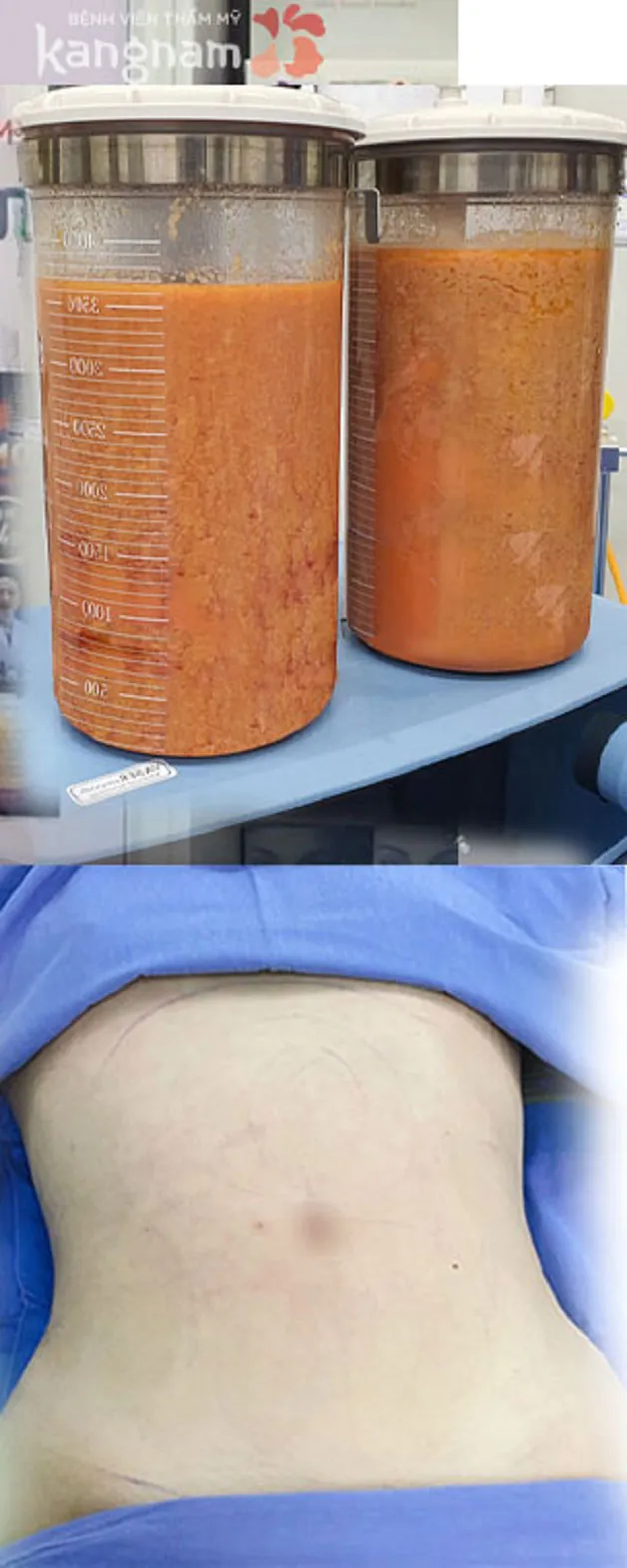 Mỡ bụng sau khi được đào thải ra ngoài 