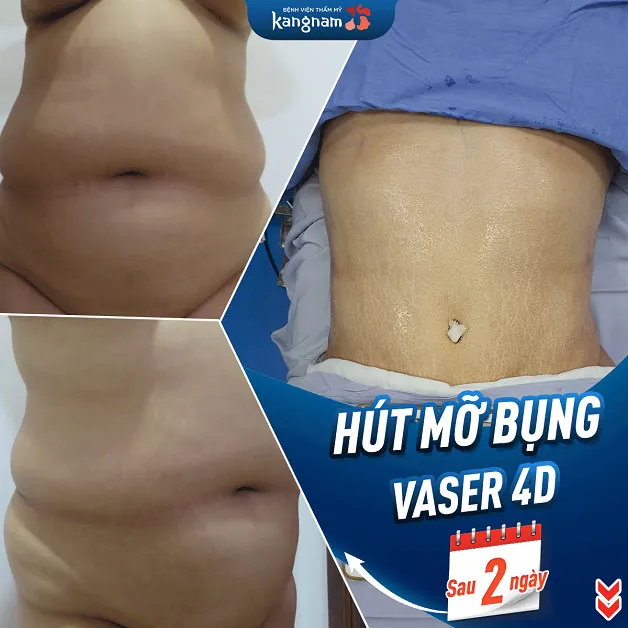 Sau 2 ngày khách hàng hút mỡ Vaser 4D
