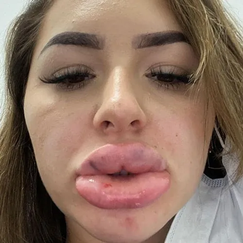 Không nên tin vào các dịch vụ bơm môi giá rẻ