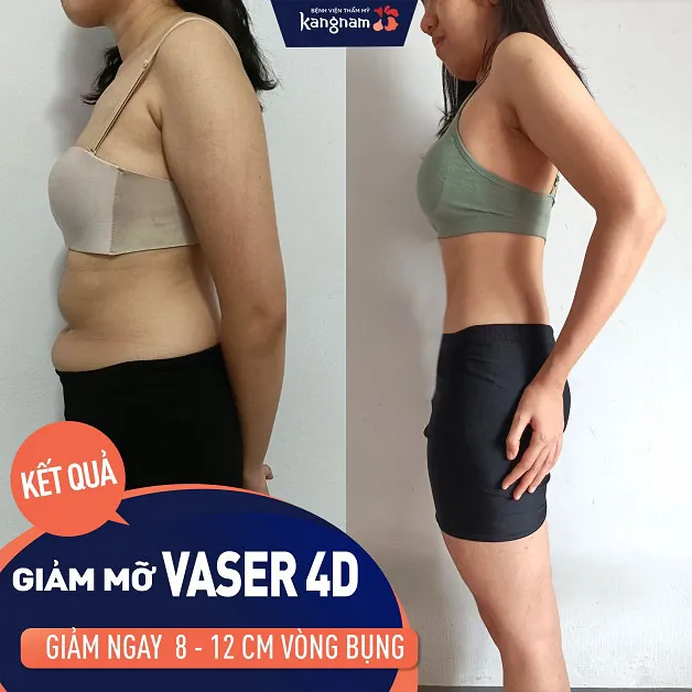 Kết quả hoàn toàn khác biệt sau khi khách hàng giảm mỡ bụng tại Kangnam