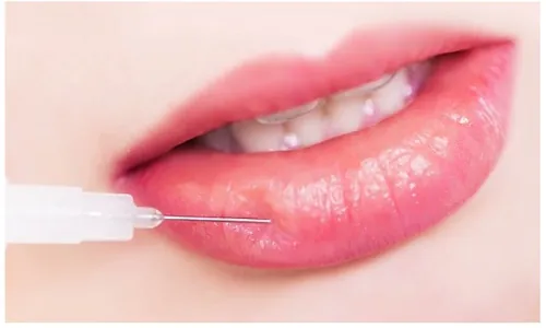 Do kỹ thuật tiêm filler của bác sĩ