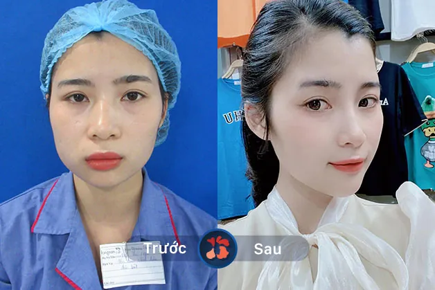 Khách hàng trước và sau khi độn cằm 