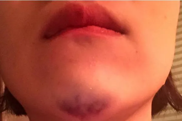 cằm bị tổn thương Cằm bị tổn thương