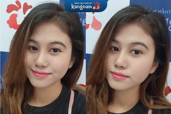 cắt môi trái tim có để lại sẹo không