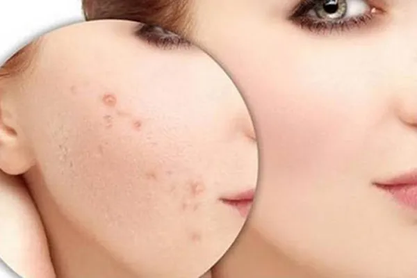 mụn ẩn mụn ẩn