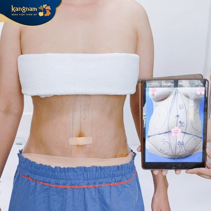 Khách hàng sau khi hút mỡ bụng tại Kangnam