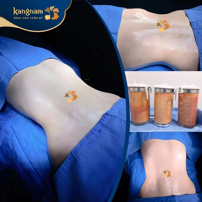 Trước bụng to và nhiều mỡ và sau khi khách hàng hút mỡ bụng trở nên thon gọn và quyến rũ hút mỡ eo dưới