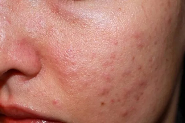 dị ứng mẩn đỏ