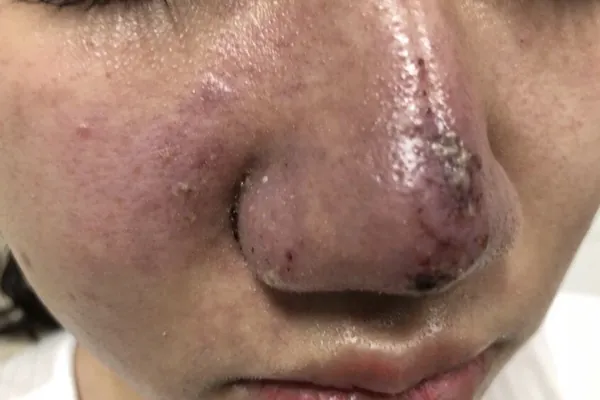 mũi bị sưng và bầm tím