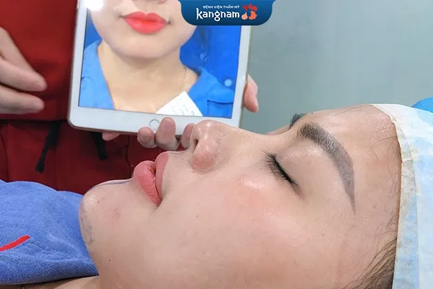 Kết quả sau khi khách hàng độn cằm tại Kangnam