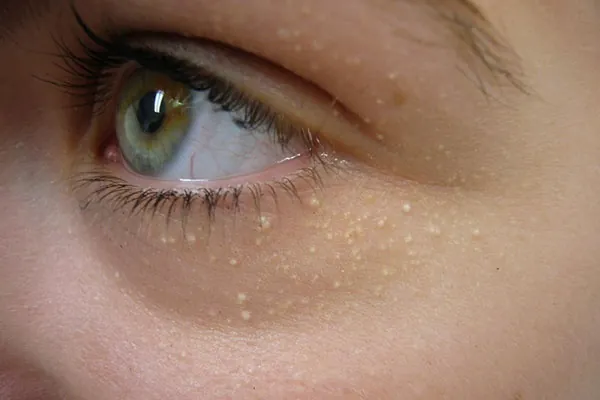 Cẩn thận khi chữa mụn thịt tại nhà