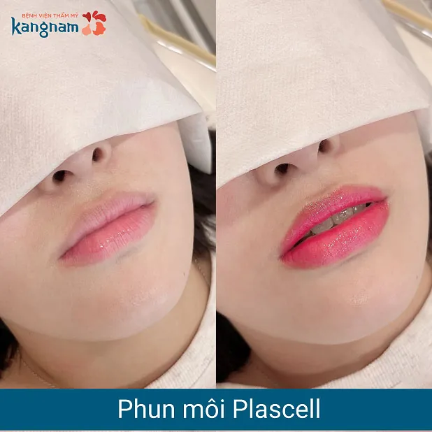Kết quả khách hàng sau khi phun môi tại Kangnam