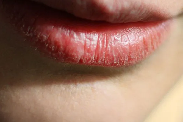Môi bong vảy sau 1 - 2 ngày