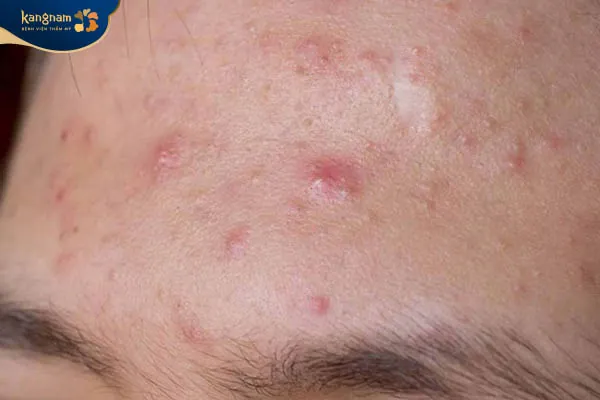 Mụn trứng cá đỏ