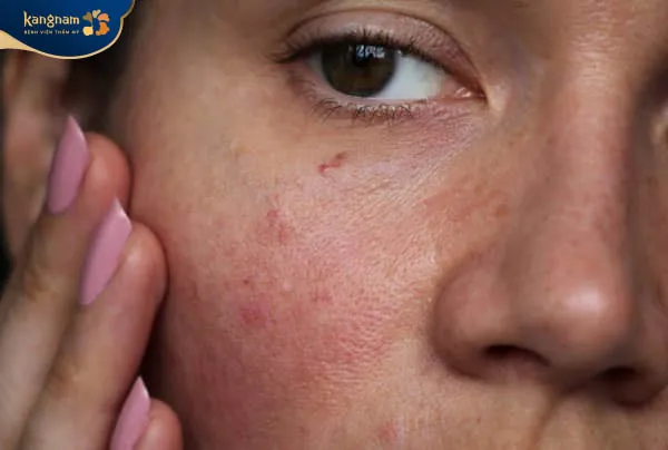 Do nền da bị thoái hóa