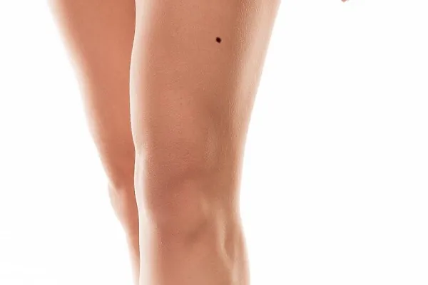 nốt ruồi nữ mọc đùi trước