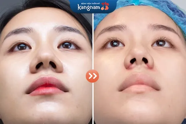 Cắt cánh mũi để khắc phục tình trạng mũi bè, chóp mũi hếch cao