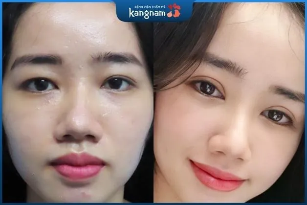 Cắt mí 6D tại Kangnam