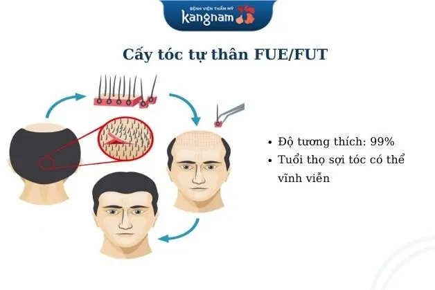 Cấy tóc cho trán cao bằng tự thân