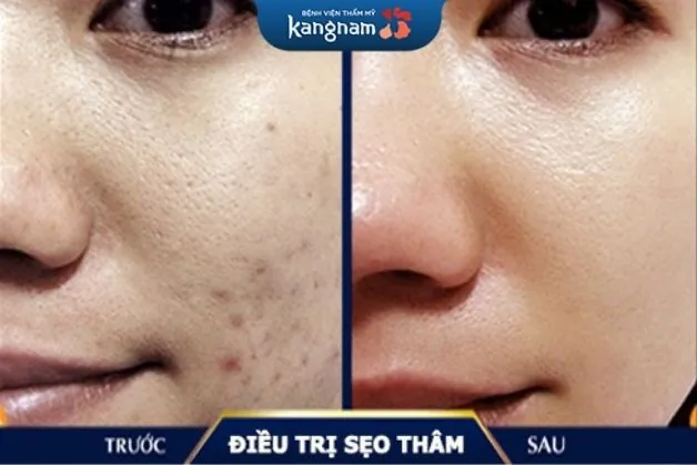 Khách hàng điều trị sẹo thâm tại Kangnam