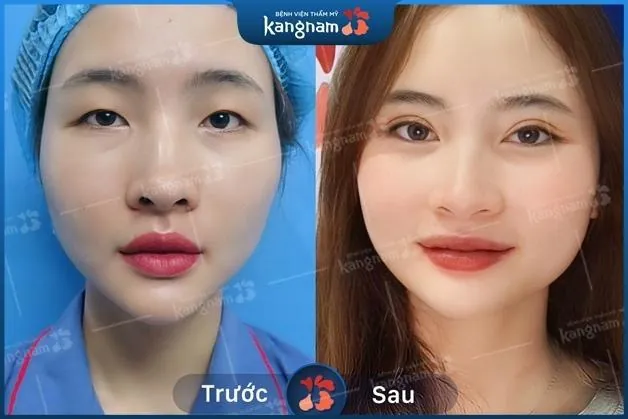 Kết quả khách hàng cắt mí đẹp tự nhiên, hợp với gương mặt