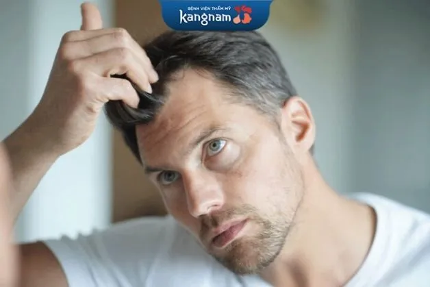 Rụng tóc 2 bên thái dương
