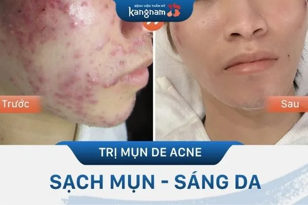 Trị mụn tại Kangnam