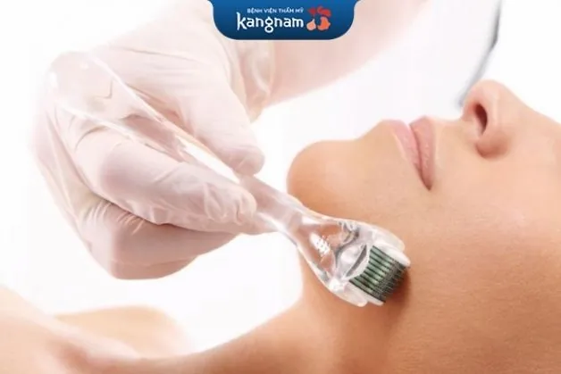 Lăn kim kết hợp serum vitamin C giúp xóa bay thâm mụn, sẹo lõm trên da