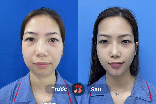 Trước và sau khi khách hàng độn cằm nội soi