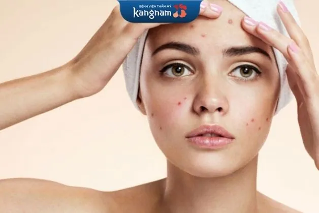 Bóp nặn mụn sai cách làm da tổn thương