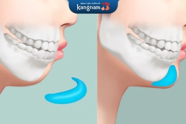 Mô phỏng phẫu thuật độn cằm nội soi