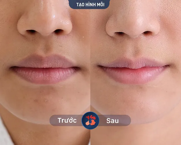 Khách hàng thực hiện thành công phun môi tại Kangnam