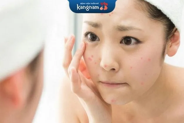 Mụn nhọt do nội tiết thay đổi