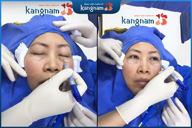 Bác sĩ thực hiện đo vẽ, phác thảo trước khi cắt mí dưới cho khách hàng
