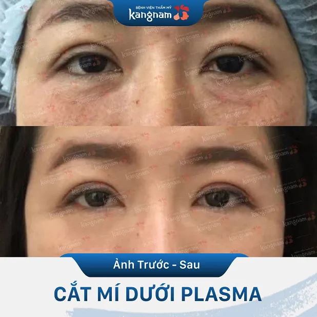 Lựa chọn địa chỉ thẩm mỹ uy tín để lấy mỡ mắt