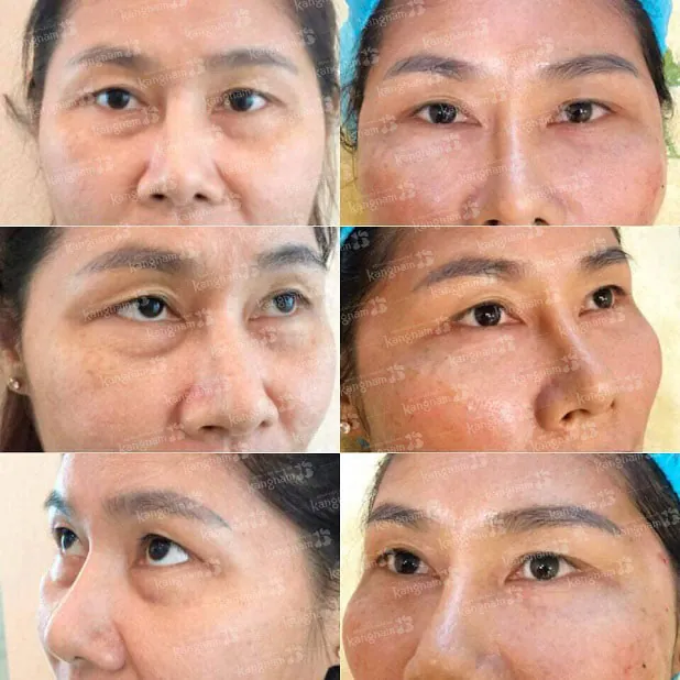 Khách hàng lấy mỡ mắt tại Kangnam sẽ được điều trị theo đúng phác đồ của Bộ Y tế