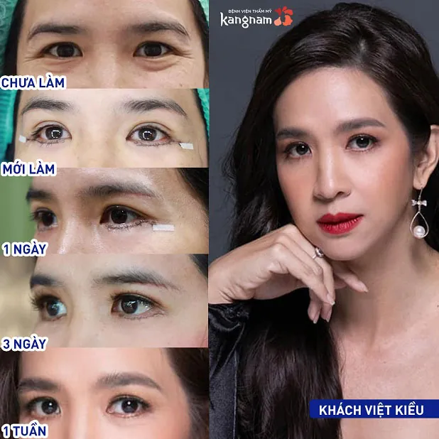 Khách hàng Việt Kiều sau 1 tuần cắt mí dưới