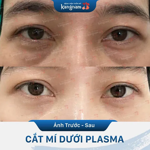HÌnh ảnh trước sau của khách hàng thực hiện cắt mí dưới tại Kangnam