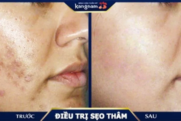 Chữa sẹo thâm hiệu quả tại Kangnam