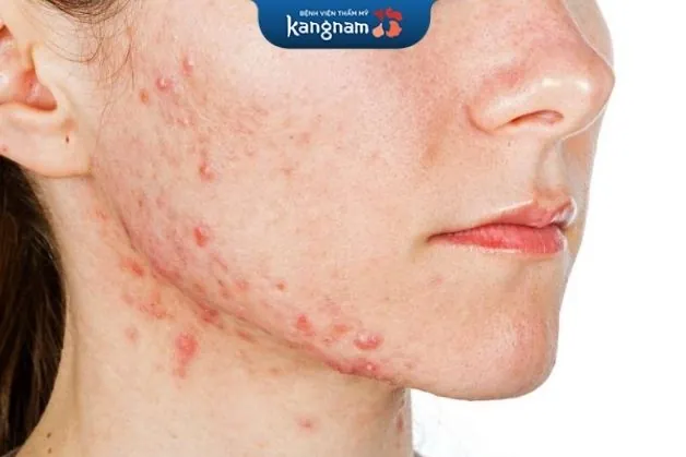 Tránh tiêu thụ thực phẩm dễ gây dị ứng