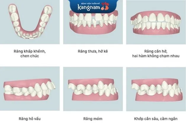 Lệch khớp cắn khiến hàm bị xấu