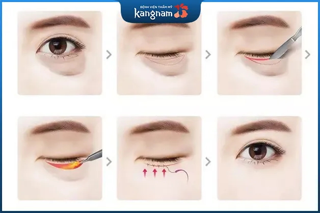 Quy trình lấy mỡ bọng mắt dưới có nguy hiểm không?