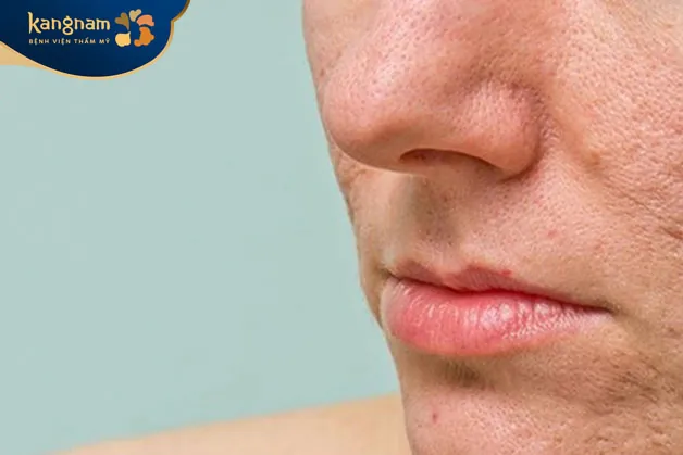 Mũi tập trung nhiều tuyến bã nhờn, dễ hình thành mụn và sẹo rỗ