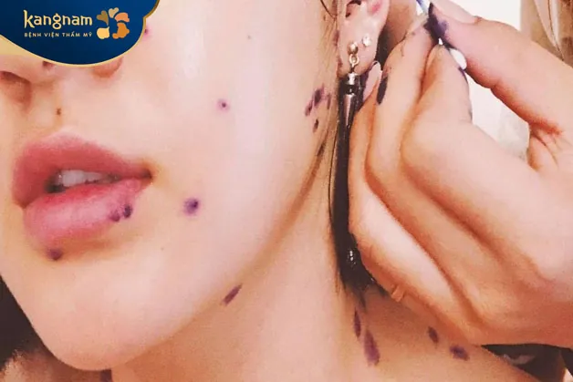 Bệnh thủy đậu gây nên sẹo rỗ