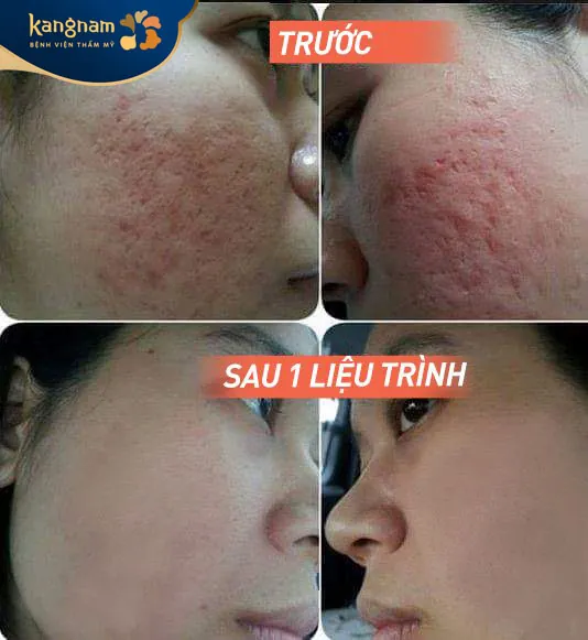 Xóa sẹo chỉ sau 1 liệu trình