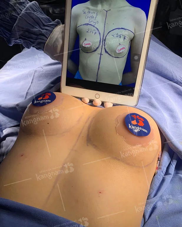 Khách hàng sau khi nâng ngực 6D