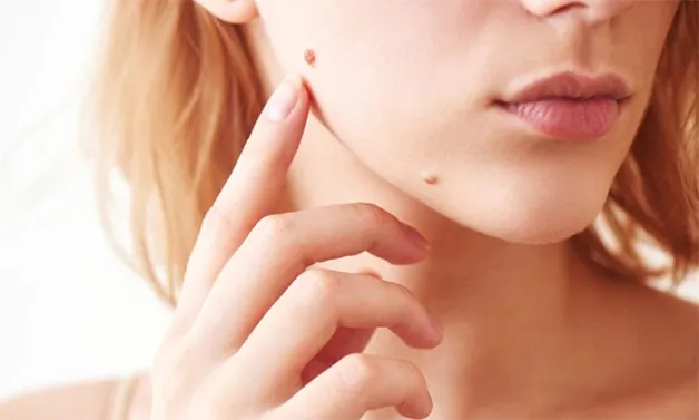 Mụn ruồi trên má phải của nữ giới là may mắn